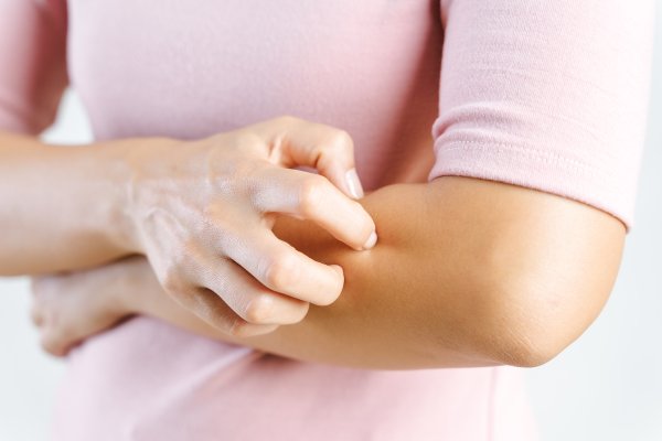 Why you should never use cortisone creams on eczema