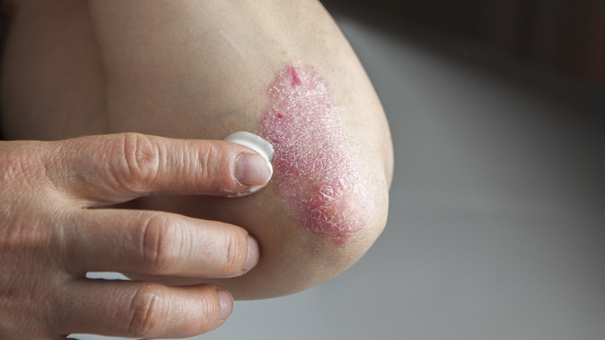 Zeolite...A natural remedy for psoriasis management.