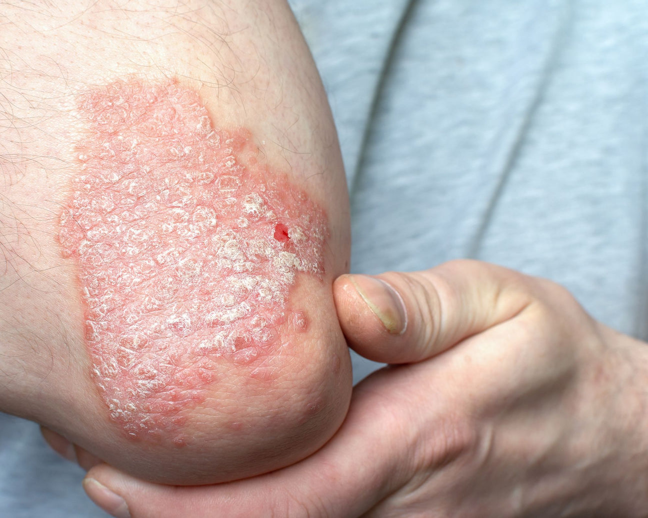 Psoriasis Relief – Natural Soaps & Healing Salve