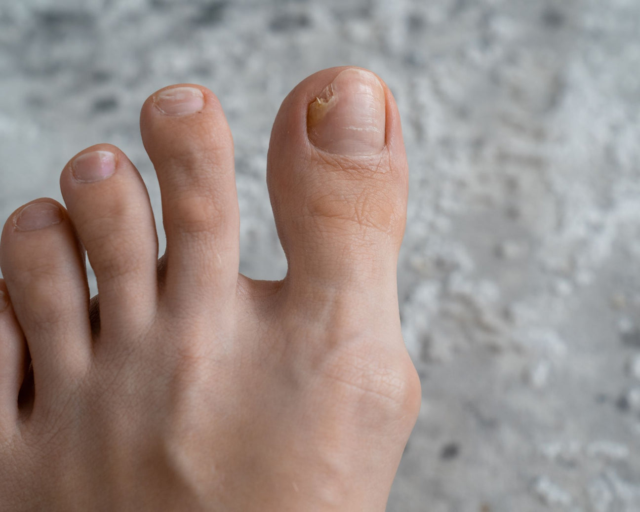 Fungal Infection
