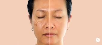 Brown Spots